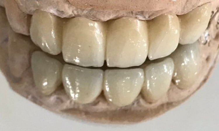 Prótese sobre modelo de gesso