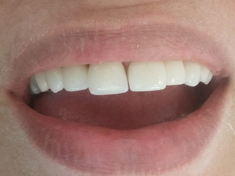 Sorriso com lentes de porcelana