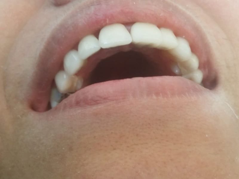 Sorriso com lentes de porcelana