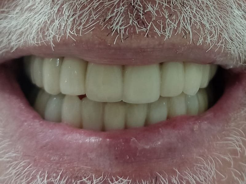 Sorriso com lentes de porcelana