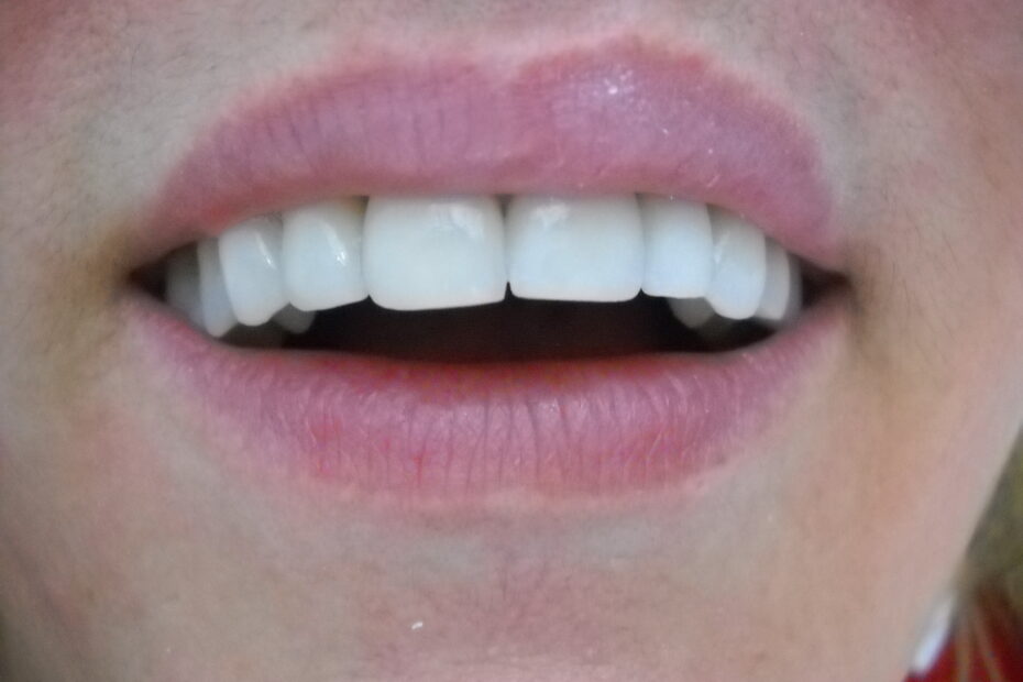 LENTES DE CONTATO DENTAL EM PORCELANA