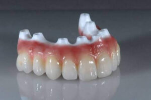 PROTESE TOTAL SOBRE IMPLANTES EM CERÂMICA