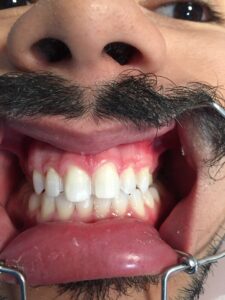 DENTES PREPARADOS