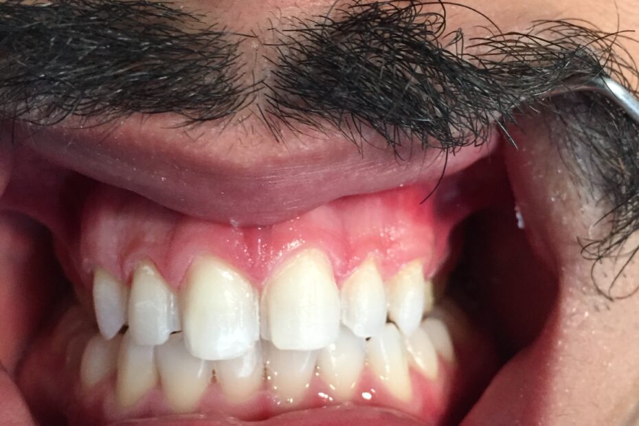 DENTES PREPARADOS