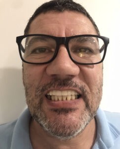 PROTESE FINAL EM PORCELANA
